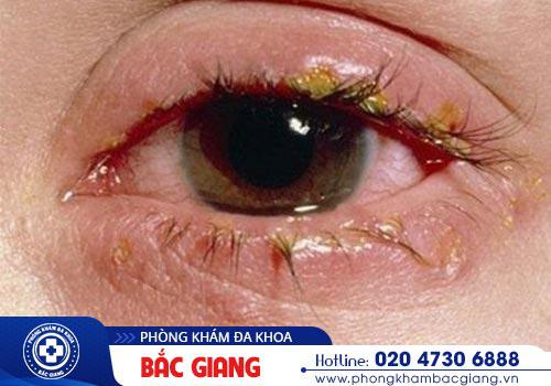 Bệnh giang mai ở nữ là gì? Có nguy hiểm không?