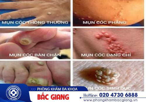 Bệnh HPV là gì? Tổng hợp những thông tin quan trọng nhất
