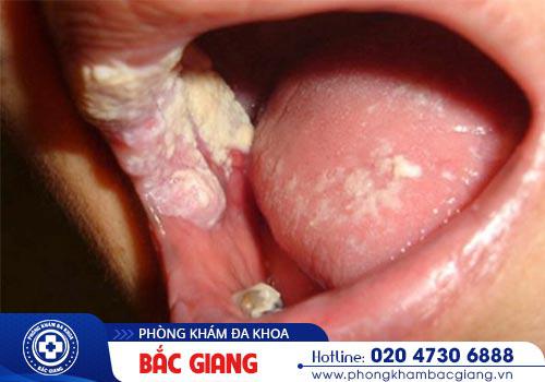 Bệnh lậu là gì? Dấu hiệu, triệu chứng bệnh lậu