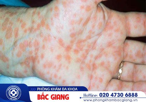 Giang mai gây ảnh hưởng rất lớn đến sức khỏe