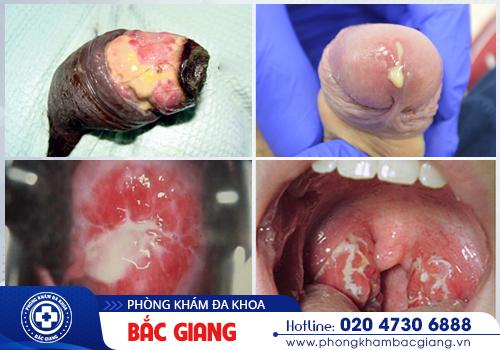 Khuẩn lậu gây nên các biểu hiện bất thường ở cơ thể người