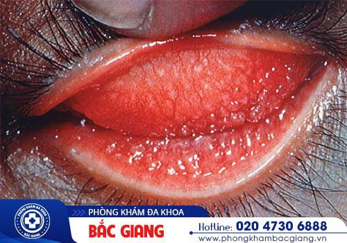 Cách chữa bệnh Chlamydia như thế nào? Địa chỉ chữa bệnh hiệu quả