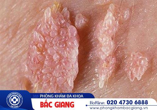 Cách chữa sùi mào gà tại nhà có hiệu quả và an toàn không?