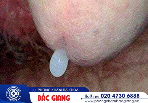 Cảnh báo nguy cơ Chlamydia gây vô sinh