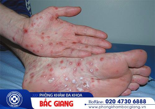 Cảnh giác với những dấu hiệu bệnh giang mai ở nam giới