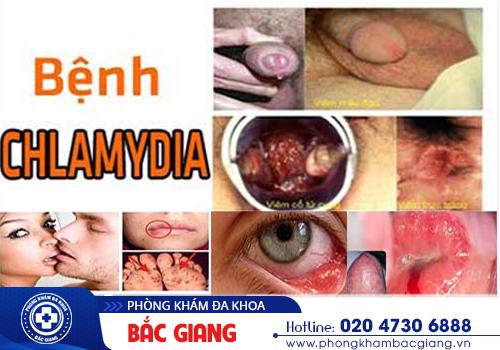 Triệu chứng bệnh Chlamydia đáng lưu ý không nên bỏ qua