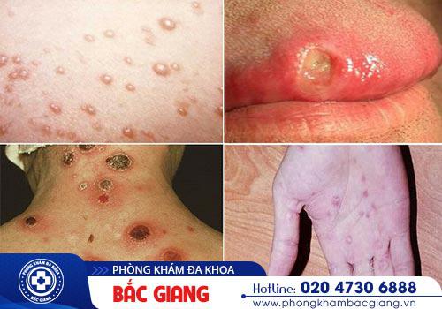 Chữa giang mai ở đâu an toàn, hiệu quả tại Bắc Giang?