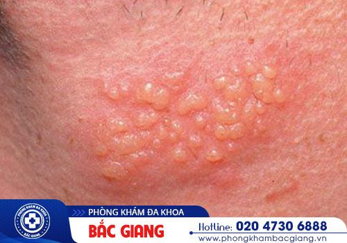 Mụn rộp sinh dục gây ra nguy hiểm đến sức khỏe khi chậm trễ hỗ trợ điều trị