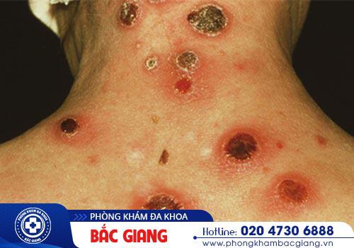 Có nên tự chữa giang mai tại nhà không?