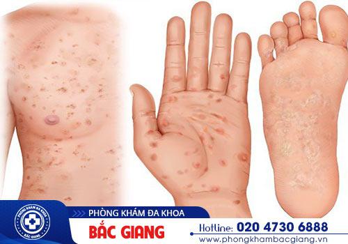 Giang mai gây biến chứng nguy hiểm nếu không kịp thời hỗ trợ điều trị