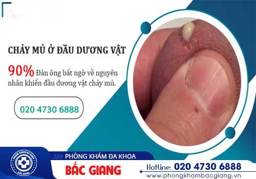 Dương vật chảy mủ - Cảnh giác với những bệnh lý nguy hiểm