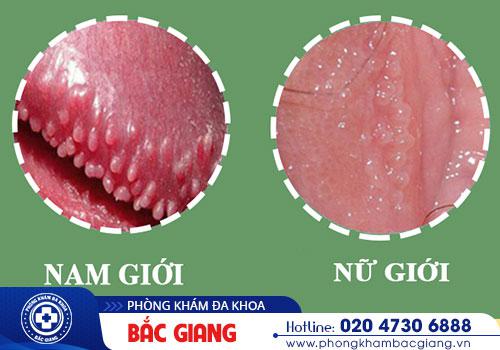 gai sinh dục gai sinh dục