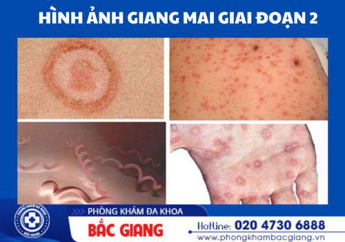 Hình ảnh bệnh giang mai giai đoạn 2. giang mai giai đoạn 2