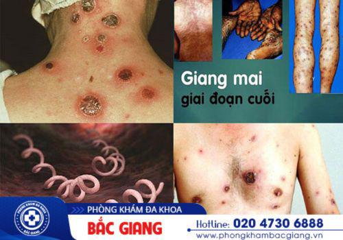 Hình ảnh bệnh giang mai giai đoạn cuối. giang mai giai đoạn cuối