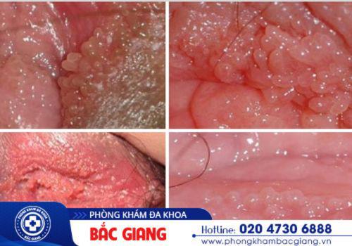 Hình ảnh bệnh hạt ngọc âm đạo. hạt ngọc âm đạo