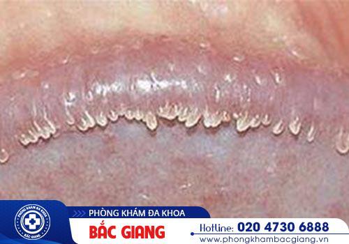 Hình ảnh hạt ngọc bao quy đầu ở nam giới. hạt ngọc bao quy đầu