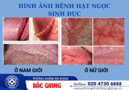 Hình ảnh bệnh hạt ngọc sinh dục ở nam và nữ. hạt ngọc sinh dục