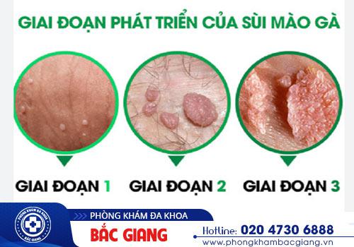 Hình ảnh nhận biết sùi mào gà qua từng giai đoạn