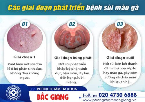 Các giai đoạn phát triển bệnh sùi mào gà của bệnh nhân