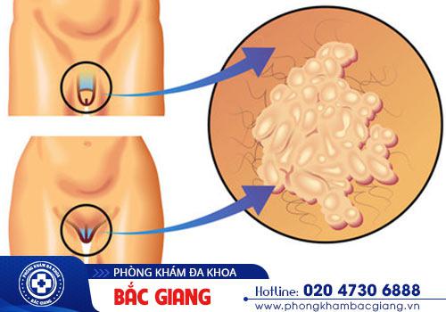 Bệnh sùi mào gà gây nên nguy hiểm nghiệm trọng khi không được hỗ trợ điều trị kịp thời