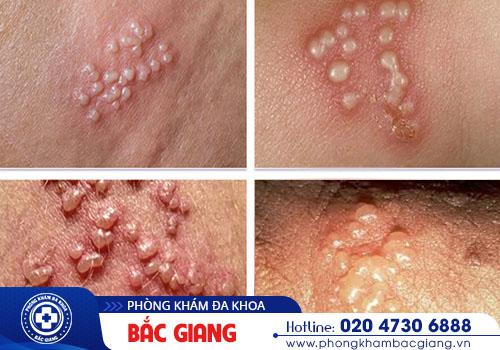 Dấu hiệu điển hình của bệnh mụn rộp sinh dục. hình ảnh mắc bệnh xã hội