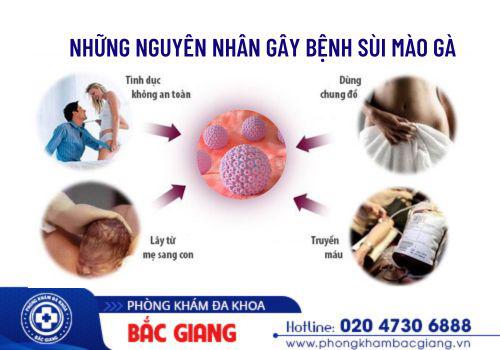 Những nguyên nhân gây sùi mào gà thường gặp. nguyên nhân gây sùi mào gà
