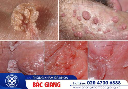 Hình ảnh bệnh sùi mào gà ở nam. sùi mào gà ở nam