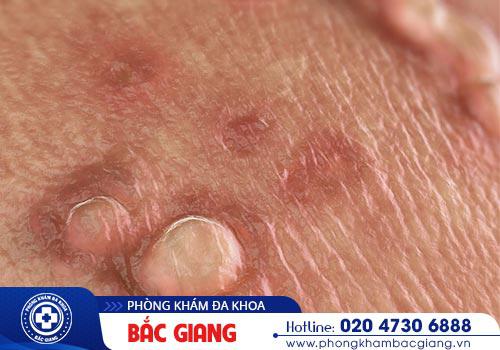 Nổi mụn vùng kín là bệnh gì? Có nguy hiểm không?