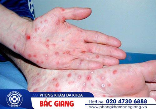 Phương pháp chữa giang mai như thế nào?