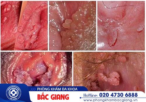 Hình ảnh sùi mào gà ở nữ. sùi mào gà ở nữ