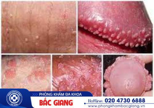 Hình ảnh bệnh sùi mào gà dương vật. sùi mào gà dương vật