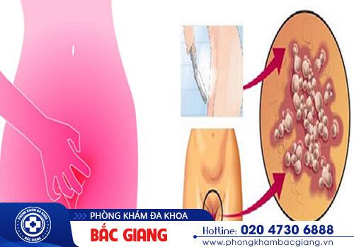 Sùi mào gà tại vùng kín gây ngứa rát và khó chịu