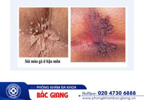 Hình ảnh sùi mào gà hậu môn. sùi mào gà hậu môn