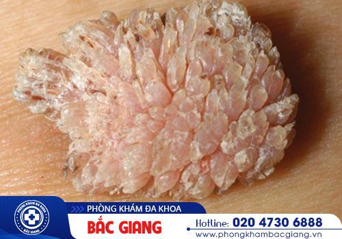 Sùi mào gà nam là gì? Có nguy hiểm không?