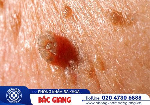 Tìm hiểu các phương pháp chữa bệnh xã hội an toàn hiệu quả hiện nay