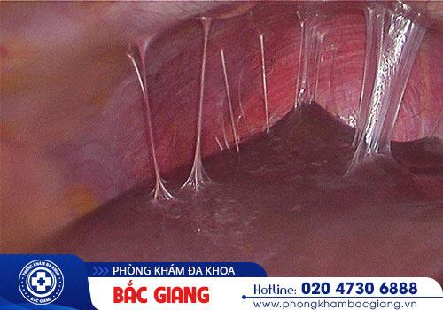 Tổng hợp các thông tin cần biết về bệnh Chlamydia