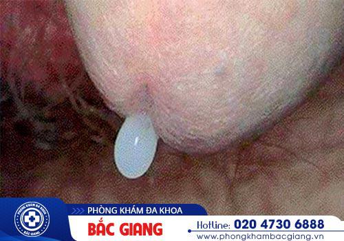 Tổng hợp các thông tin cần biết về bệnh Chlamydia