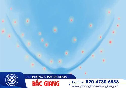 Mụn âm đạo tăng nguy cơ nguy hiểm đến sức khỏe nữ giới