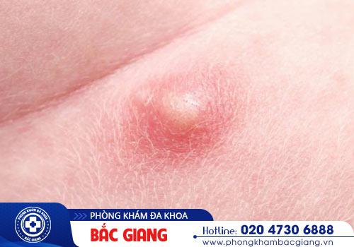Mụn dương vật cảnh báo những bệnh nguy hiểm cần hỗ trợ điều trị sớm