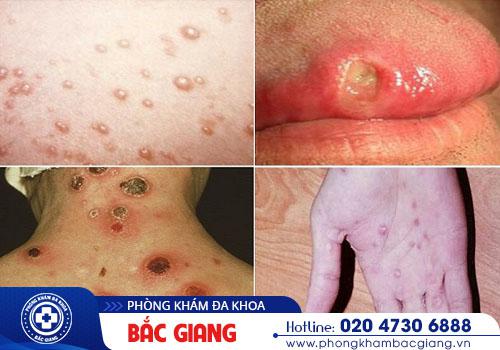 Hình ảnh bệnh giang mai. hình ảnh mắc bệnh xã hội