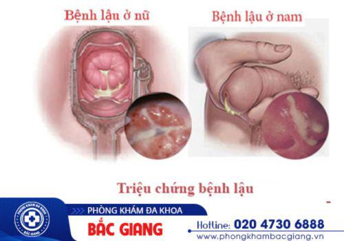 Biểu hiện của bệnh lậu ở nam và nữ. hình ảnh mắc bệnh xã hội