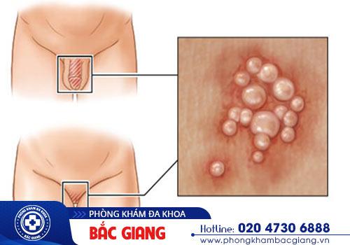 Herpes sinh dục gây ảnh hưởng lớn đến sức khỏe bệnh nhân khi chậm trễ điều trị